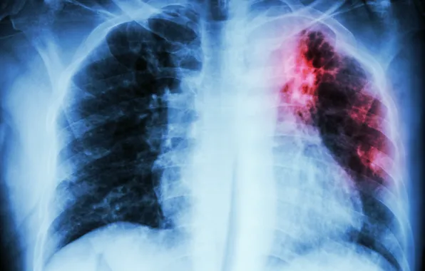 Stain, disease, lungs, radiography, infection