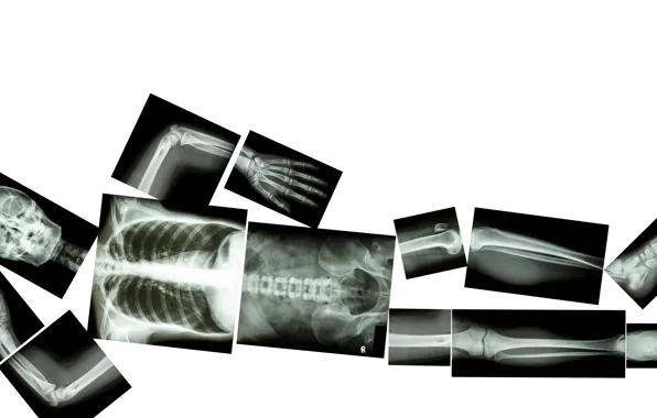 Picture pose, bone plates, X-rays