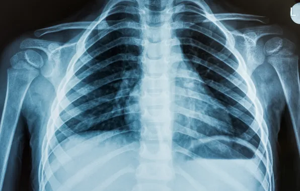 Picture man, chest, ribs, x-ray