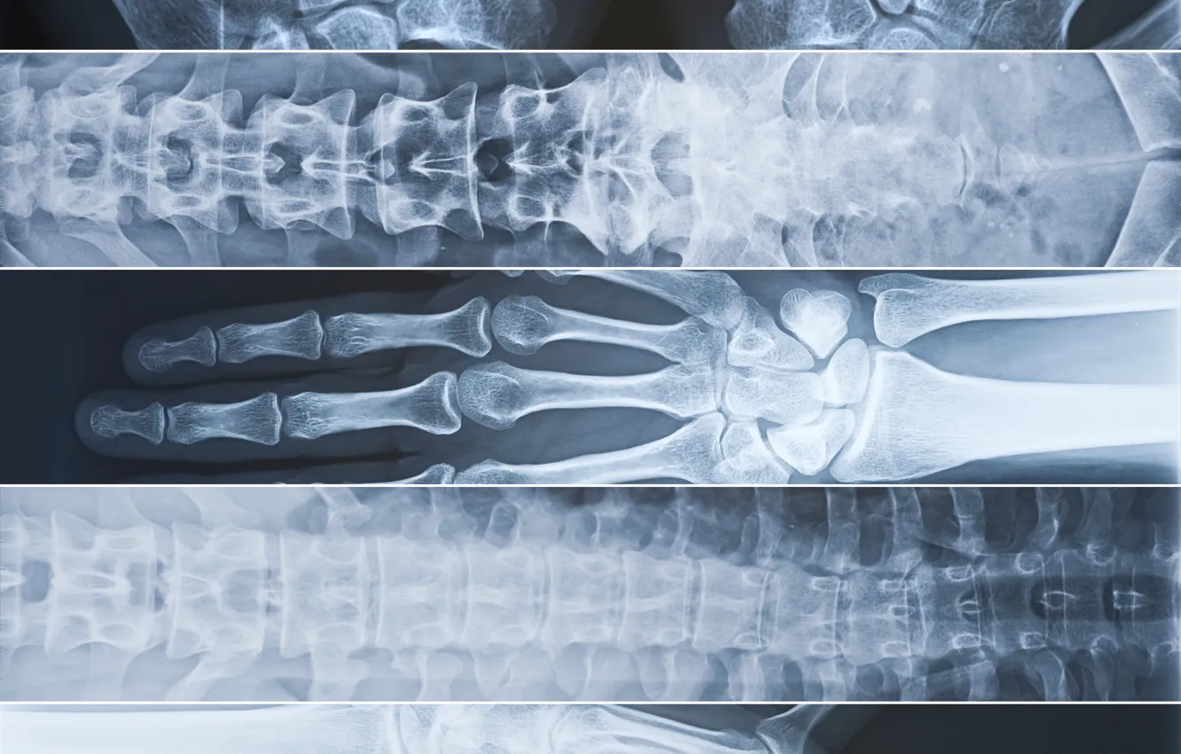 Photo wallpaper hands, fingers, spine, Radiographs