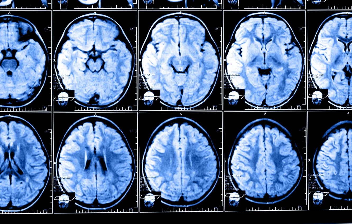 Photo wallpaper brain, studies, X-rays